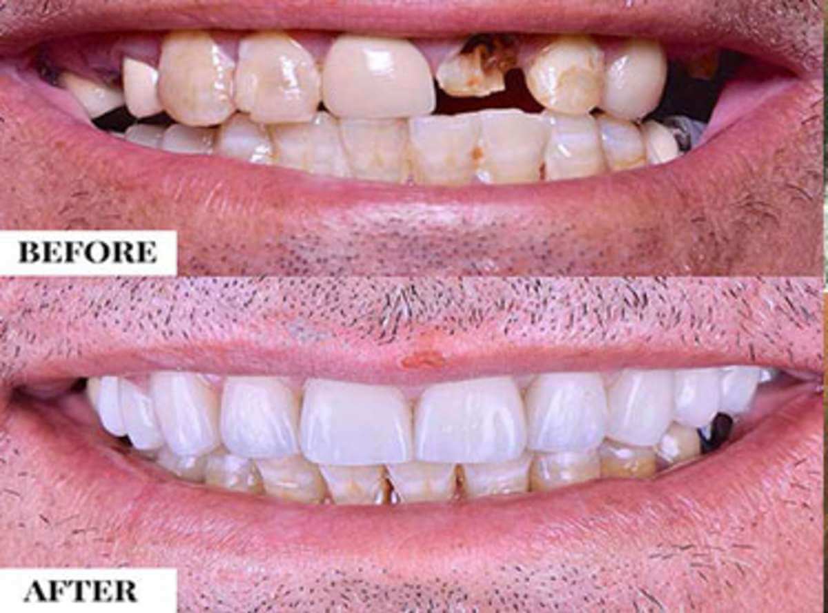 Toothache (Tooth Pain) Treatment near me